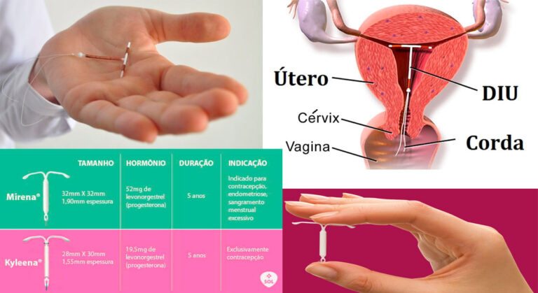 Qual o Melhor DIU? Veja as diferenças do hormonal, cobre e prata