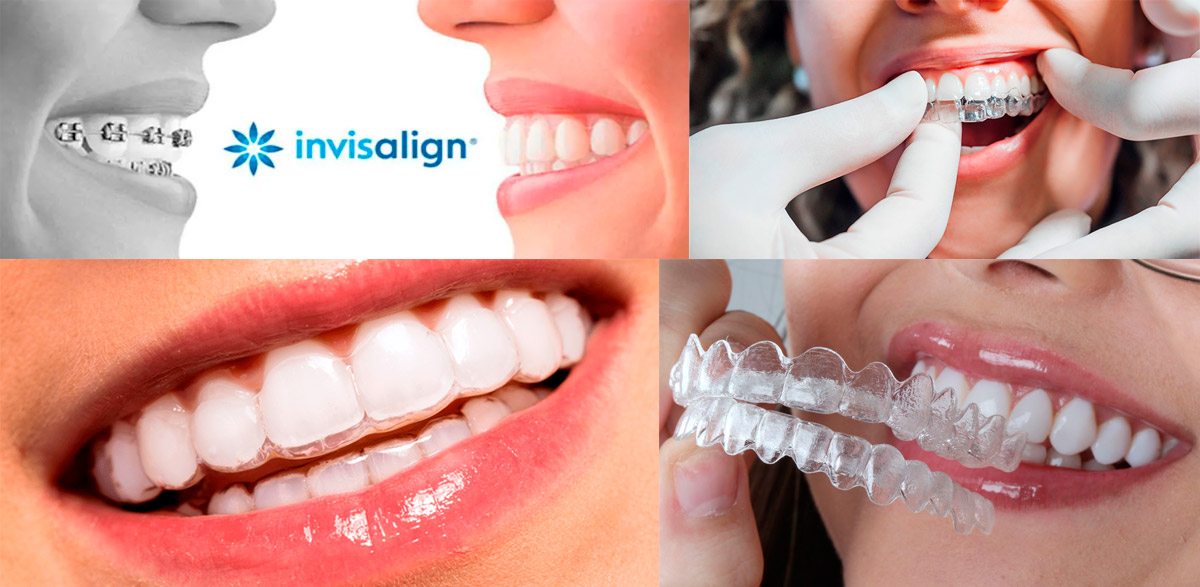 invisalign quanto custa