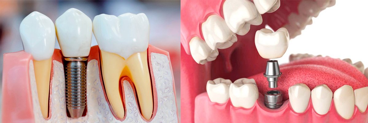 quanto custa implante dentário