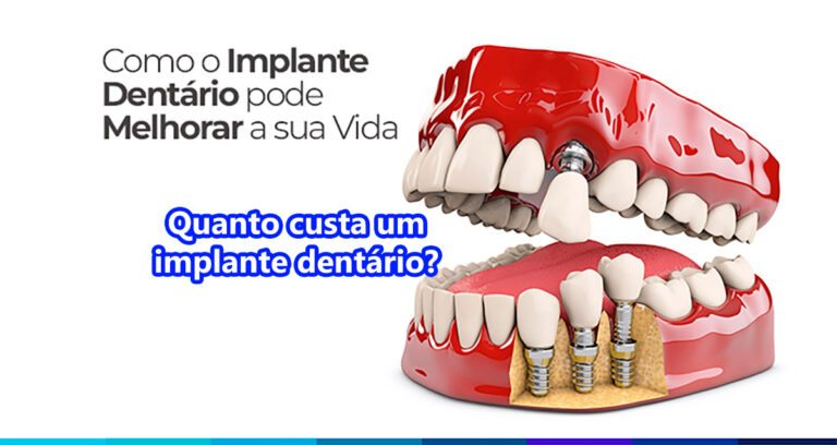 Quanto custa um implante dentário? Veja valores reais