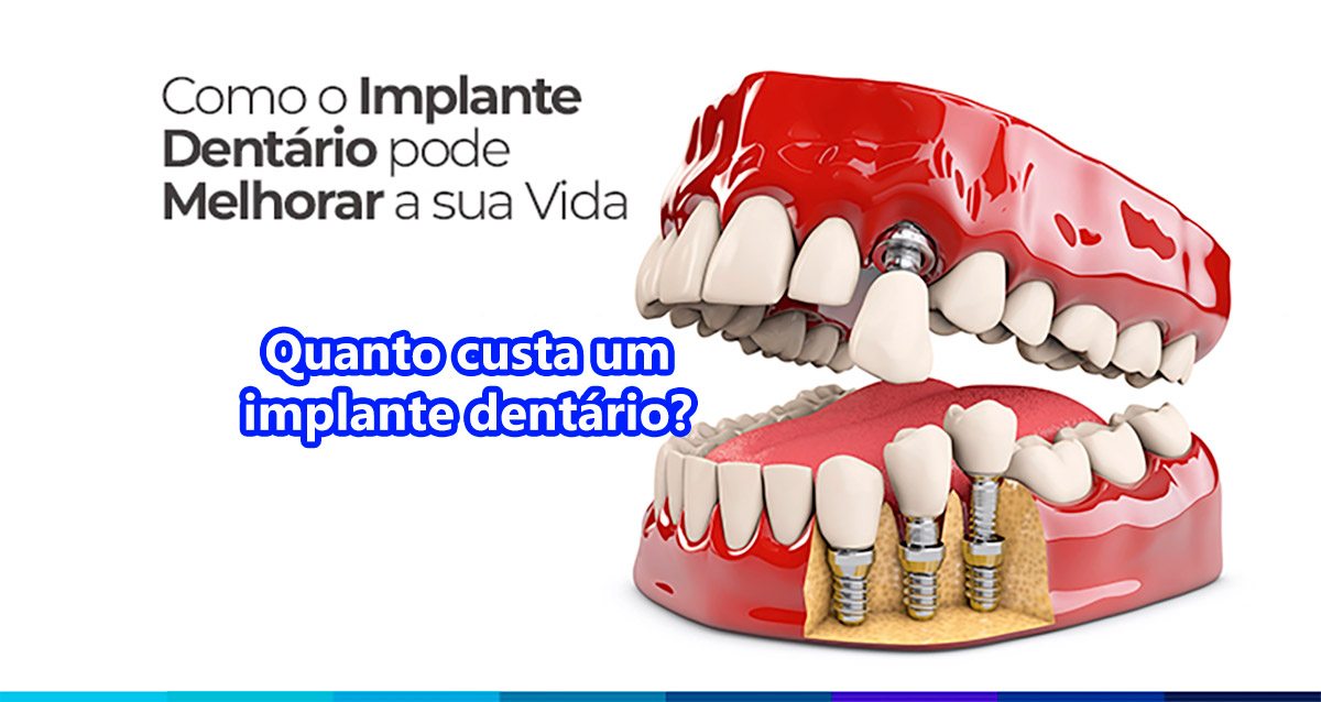 quanto custa um implante dentário